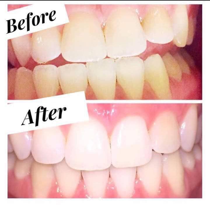Whitening Toothpaste