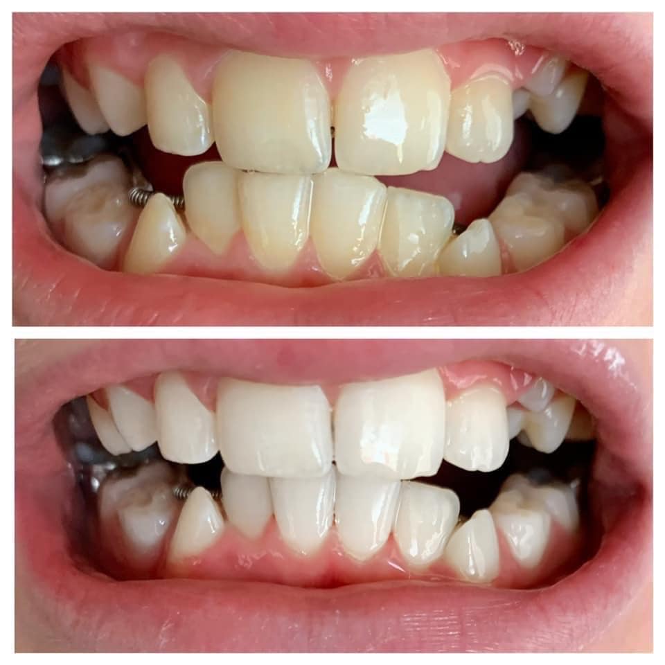 Whitening Toothpaste