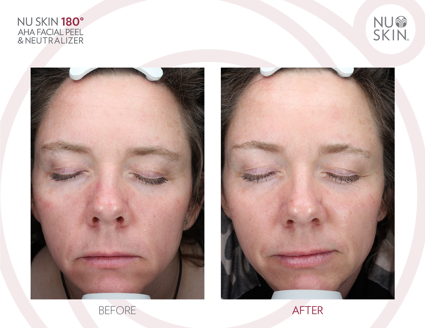 180 AHA Facial Peel