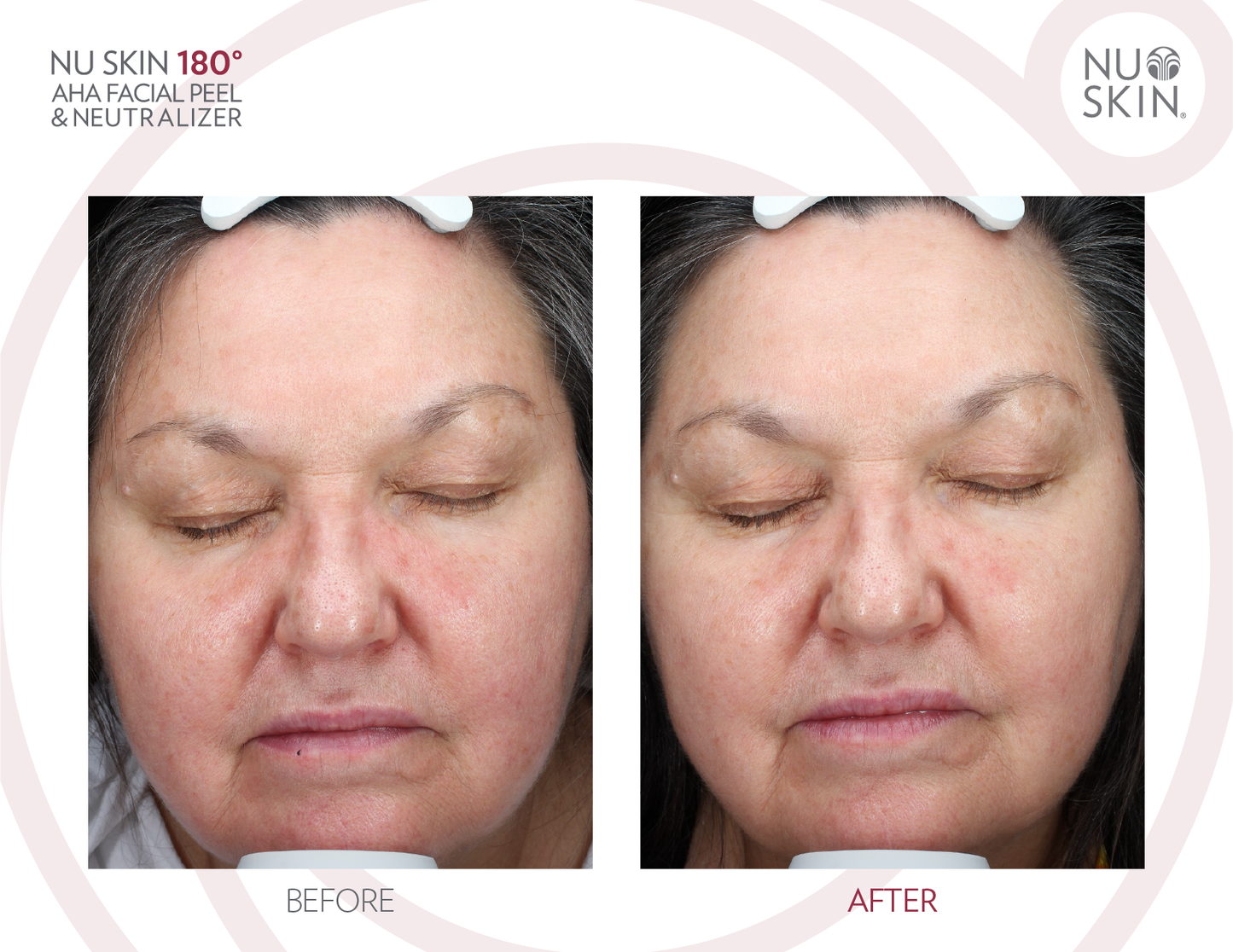 180 AHA Facial Peel
