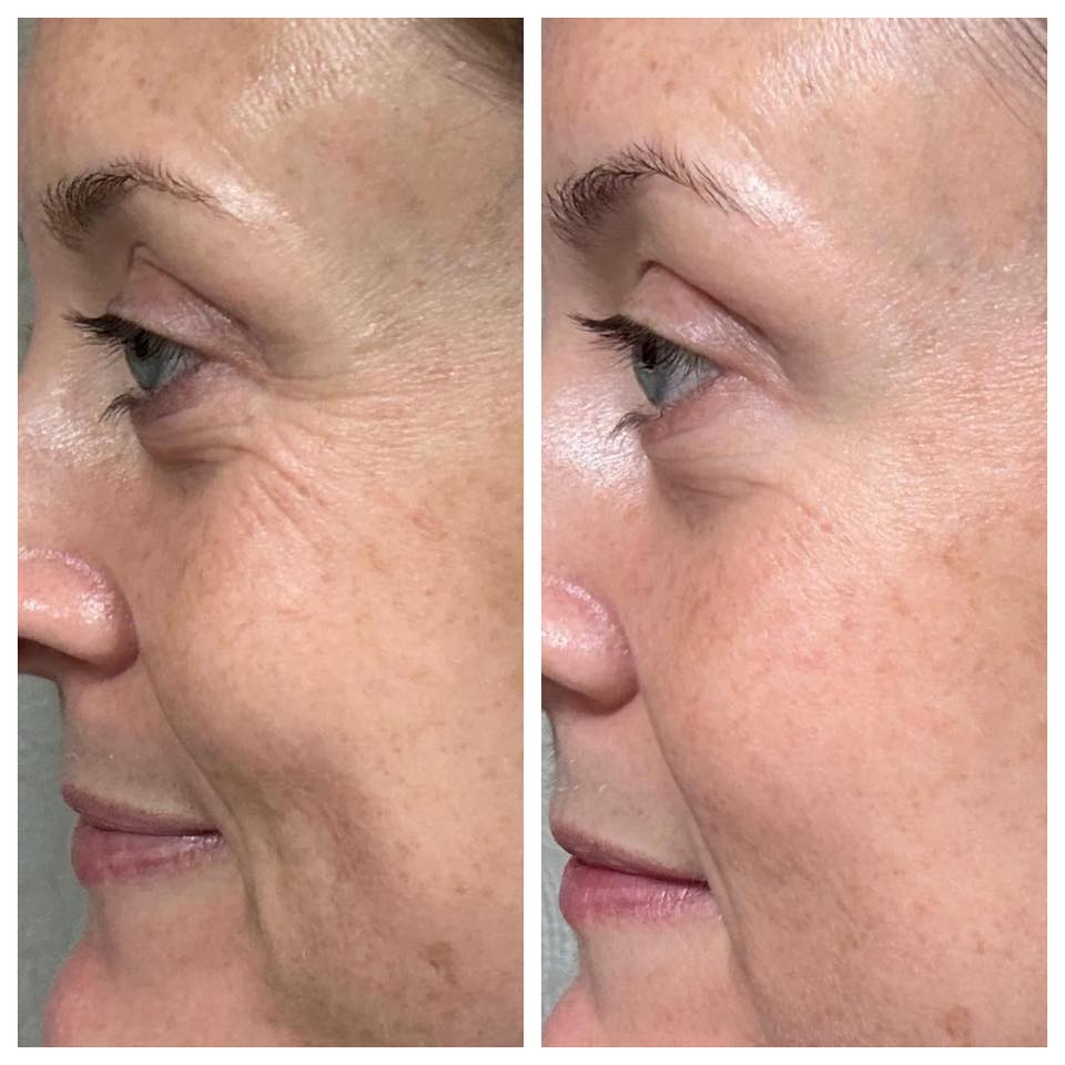 NEW!! - Microneedling Tool + Line Corrector Bundle