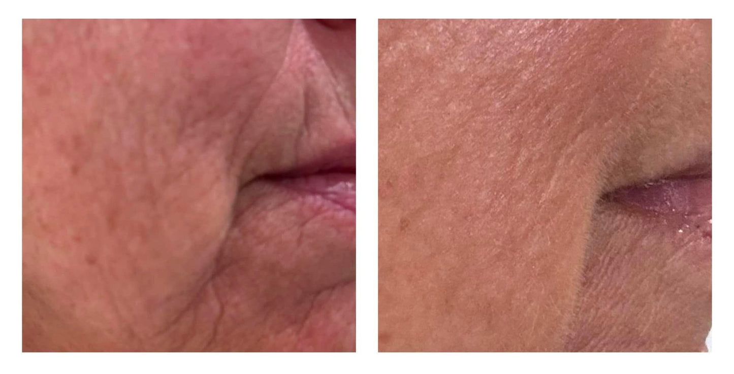 NEW!! - Microneedling Tool + Line Corrector Bundle