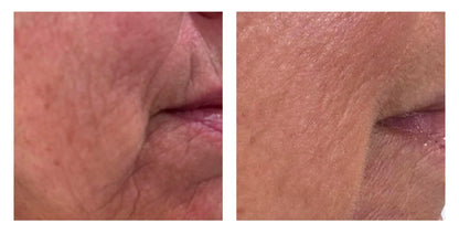 NEW!! - Microneedling Tool + Line Corrector Bundle